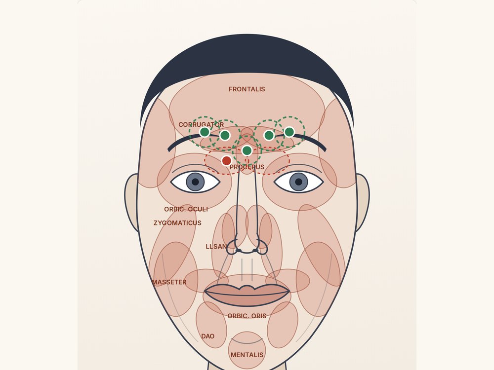 A face with the facial muscles overlaid and injection points marked on the glabella